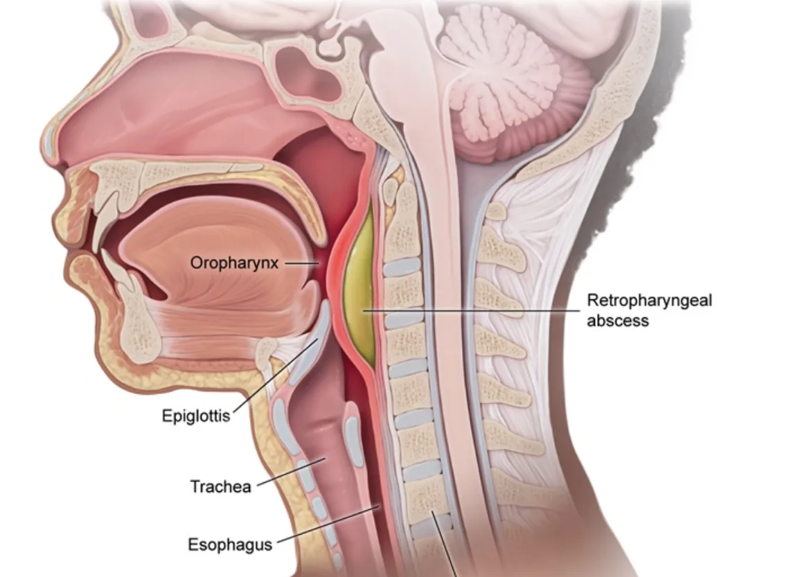 Retropharyngeal and Parapharyngeal Abscess Drainage at Niraaya Hospital