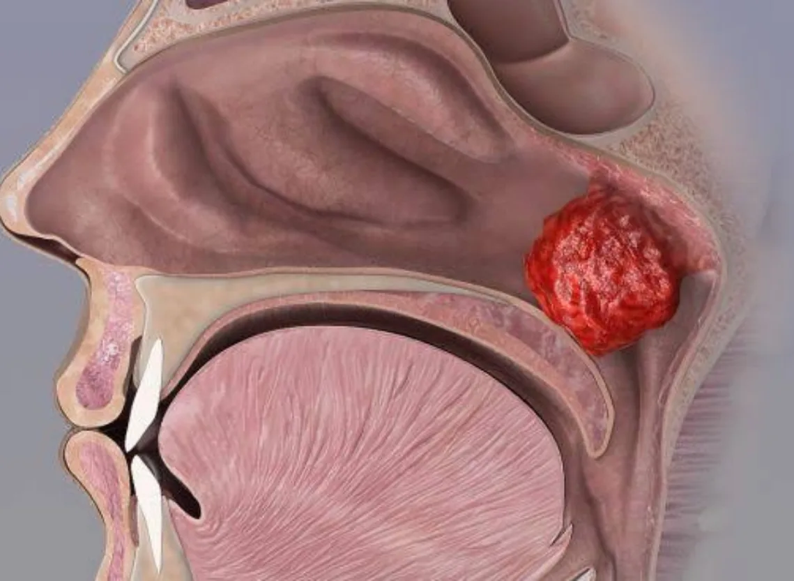 Adenoidectomy at Niraaya Hospital