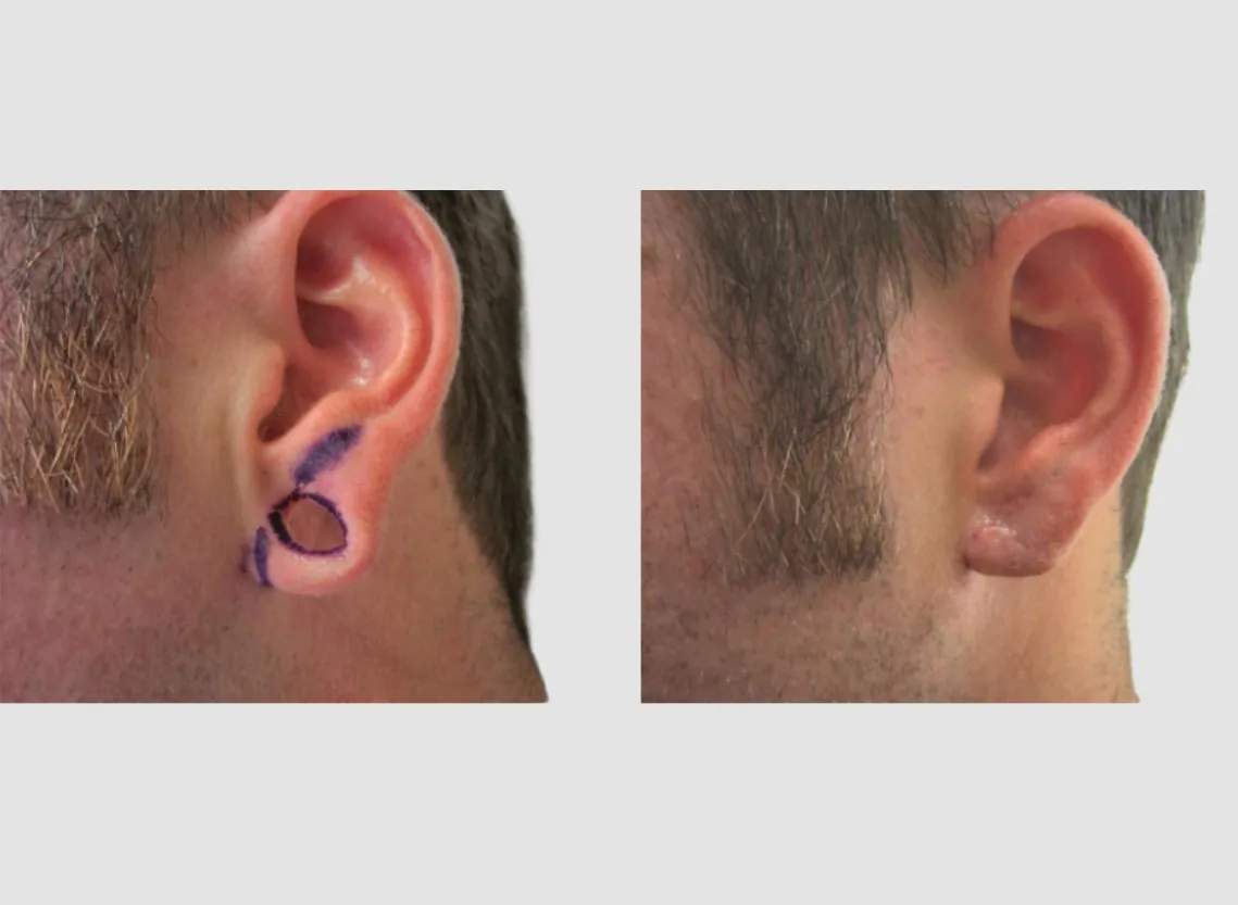 Ear lobe repair at Niraaya Hospital