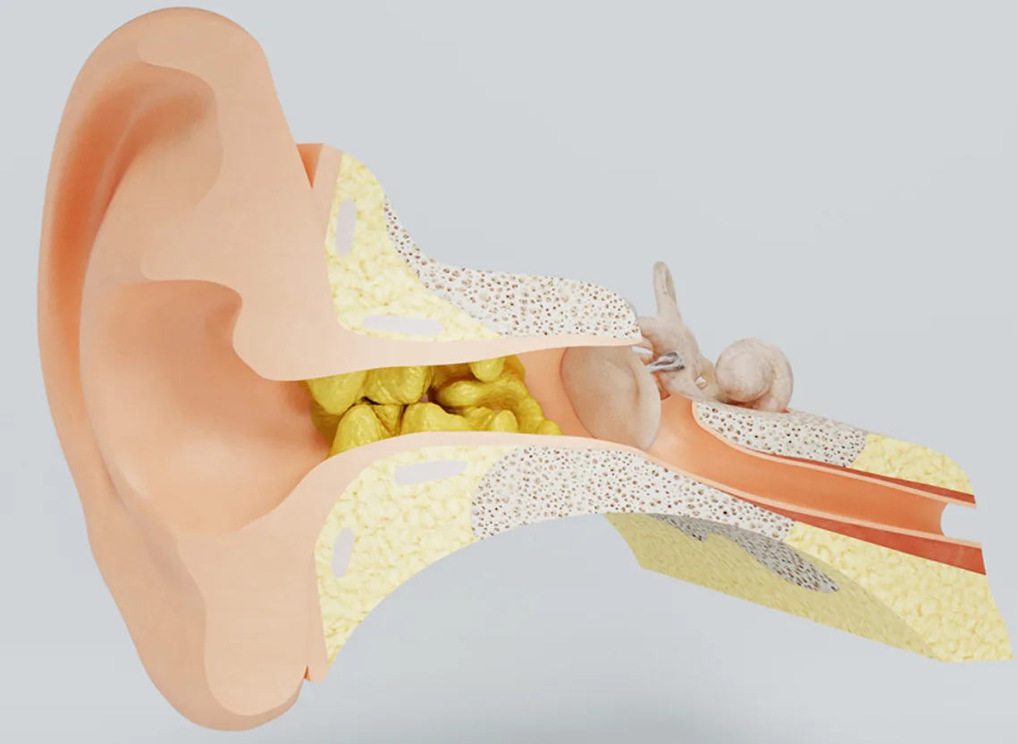 Ear Wax Impaction (Cerumen Impaction) at Niraaya Hospital