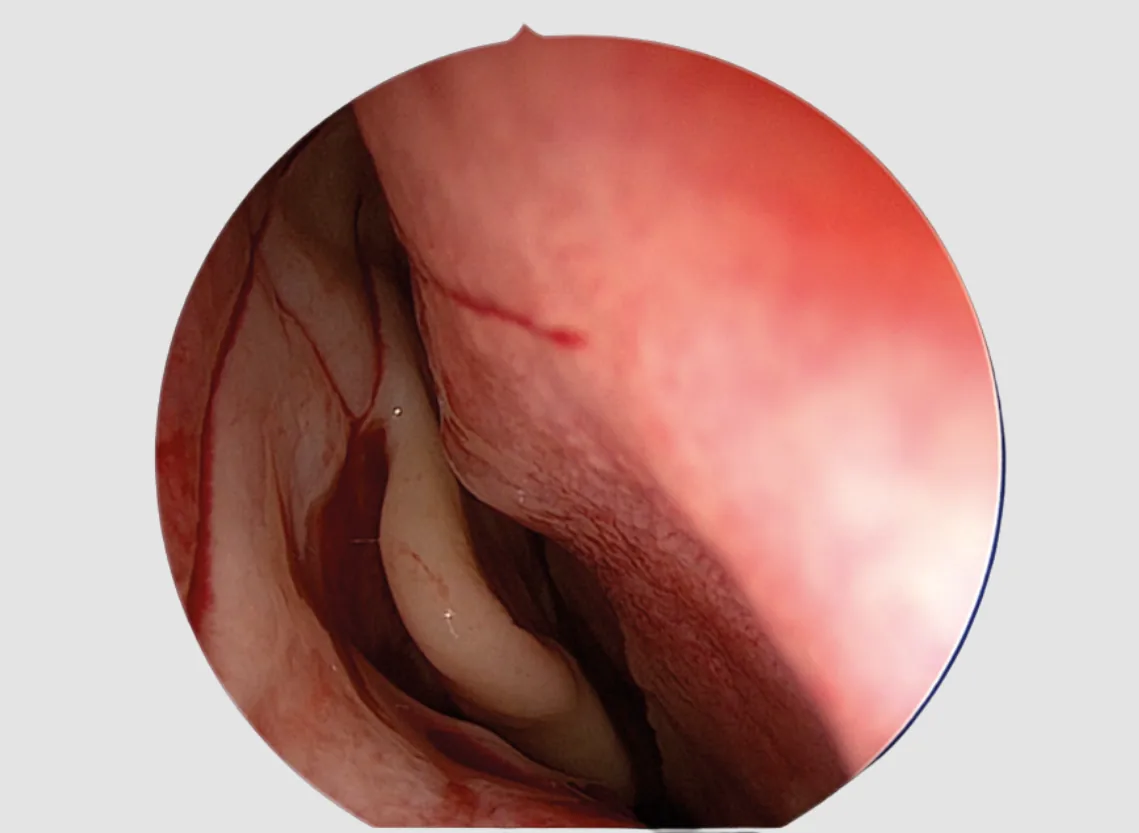 Endonasal Dacryocystorhinostomy (Endonasal DCR) at Niraaya Hospital