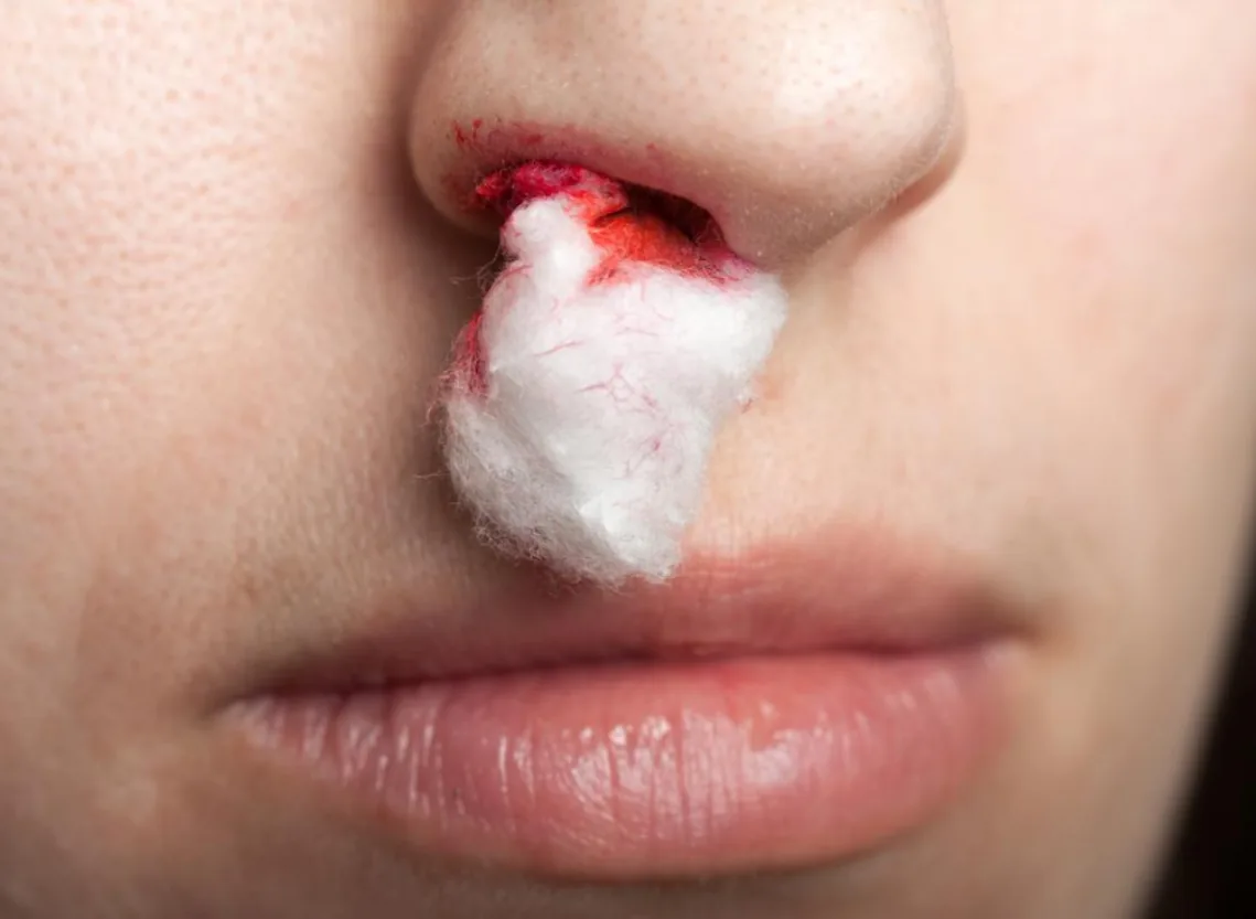 Epistaxis (Nosebleeds) at Niraaya Hospital