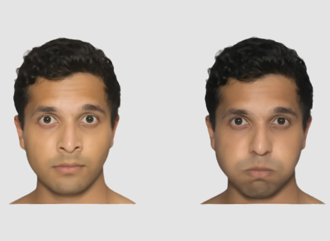 Facial Weakness (Ear-Related Facial Nerve Palsy) at Niraaya Hospital
