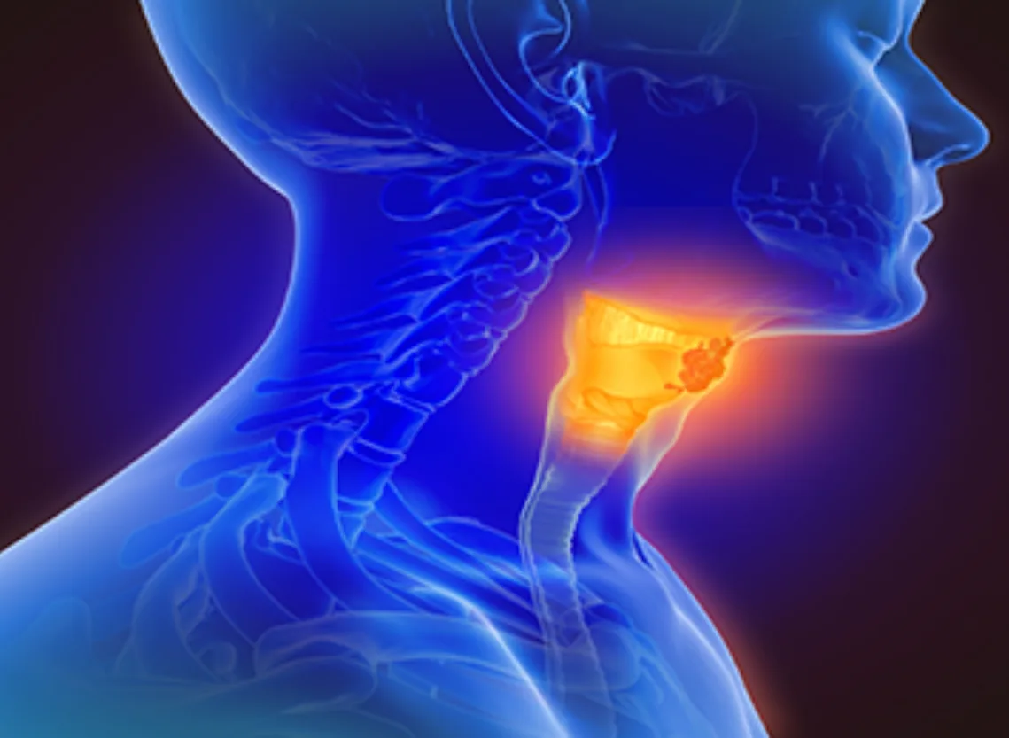 Hypopharyngeal Cancer at Niraaya Hospital