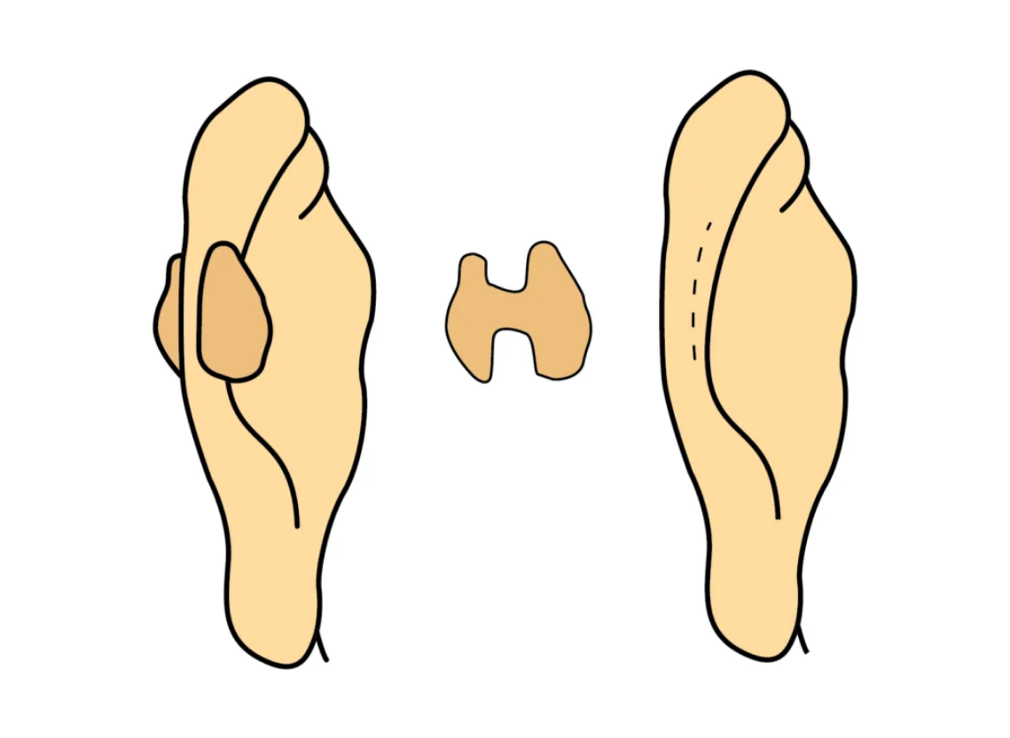 Keloid excision care at Niraaya Hospital
