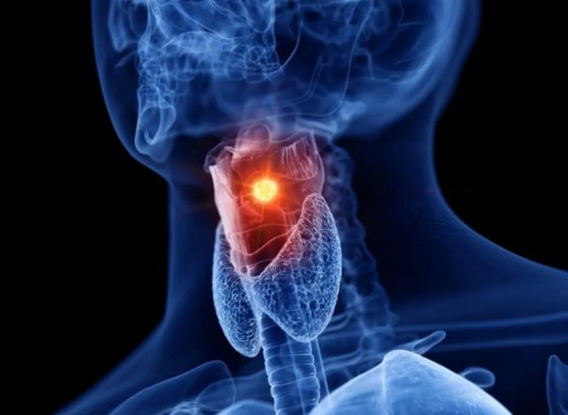 Laryngeal Cancer (Voice Box Cancer) at Niraaya Hospital