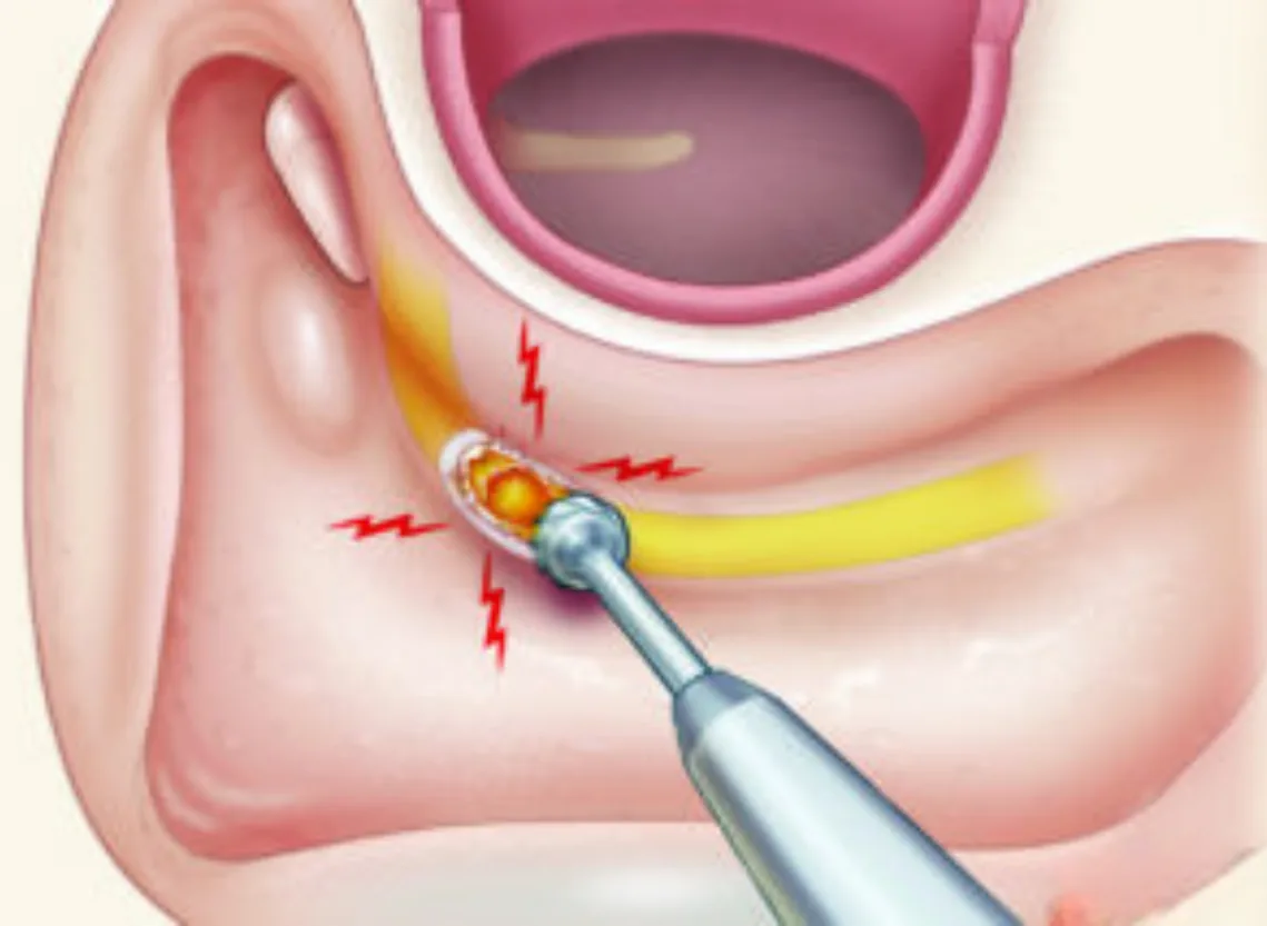 Mastoidectomy care at Niraaya Hospital