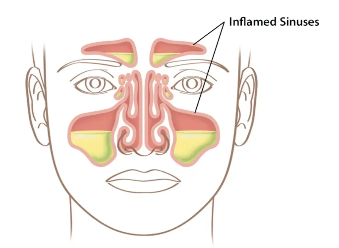 Nasal Blockage and Congestion at Niraaya Hospital