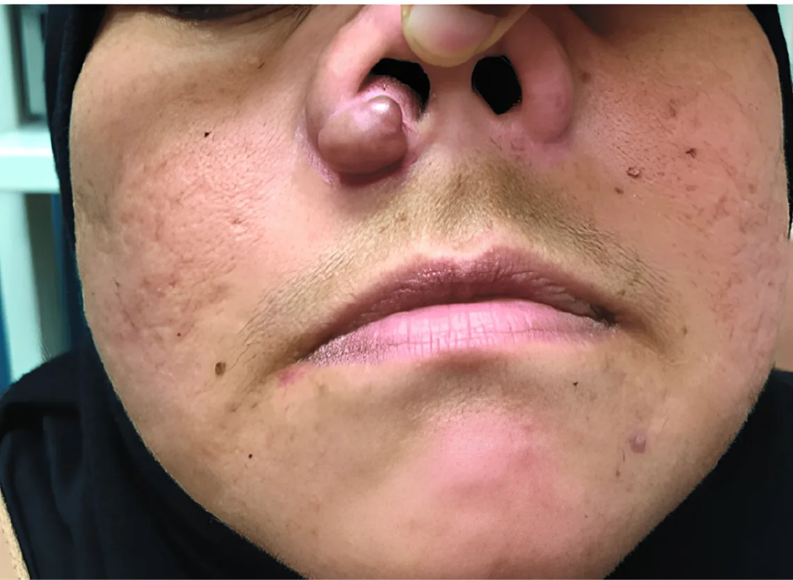 Nasal Mass Excision at Niraaya Hospital