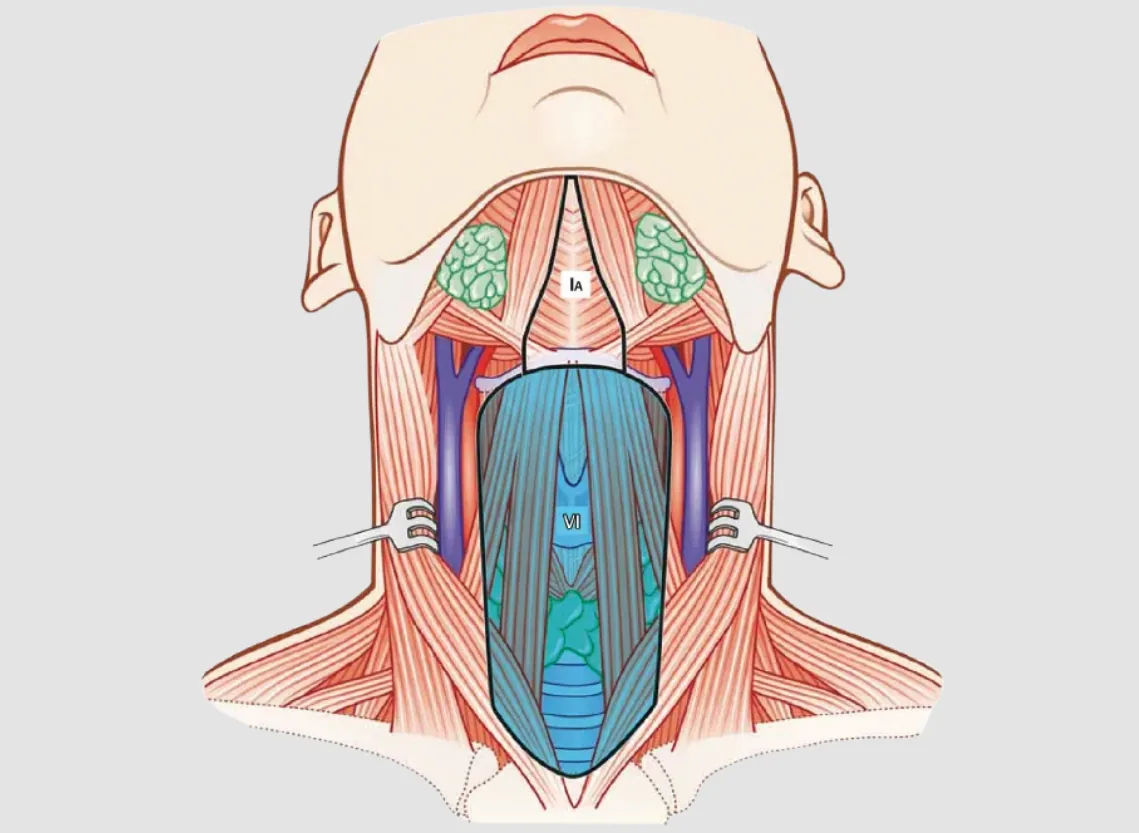 Neck Dissection at Niraaya Hospital