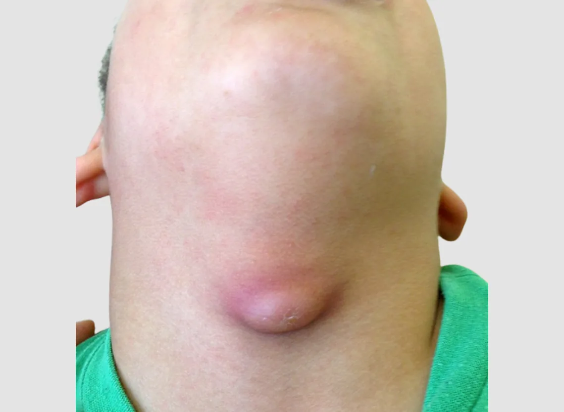 Neck Masses and Lymph Node Metastasis at Niraaya Hospital