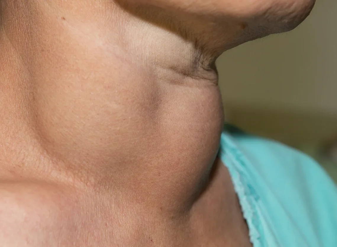 Neck Swellings and Lumps at Niraaya Hospital