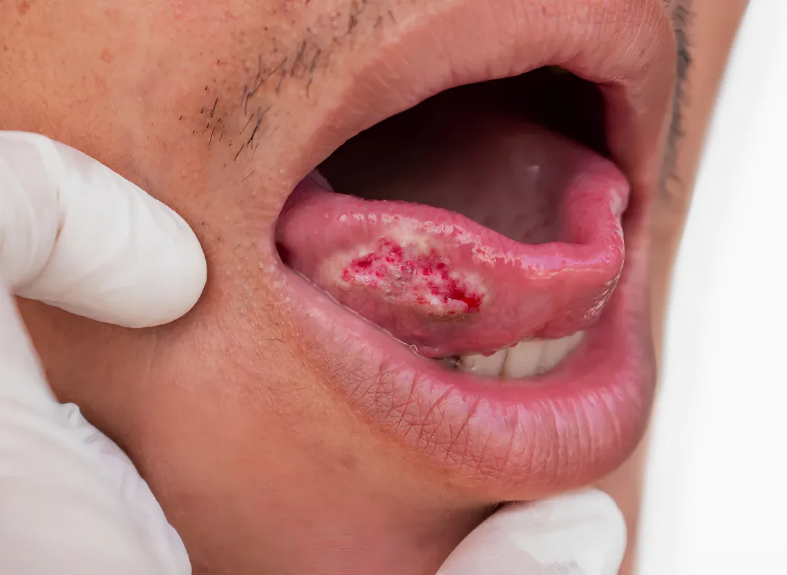 Oral Cavity Cancer at Niraaya Hospital