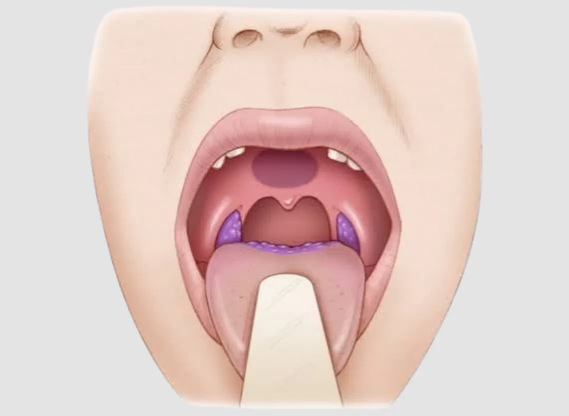 Oropharyngeal Cancer at Niraaya Hospital