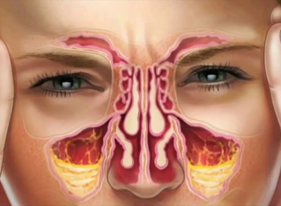 Post-Nasal Drip at Niraaya Hospital