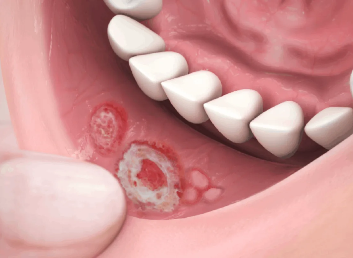 Recurrent Oral Ulcers (Aphthous Stomatitis and Beyond) at Niraaya Hospital