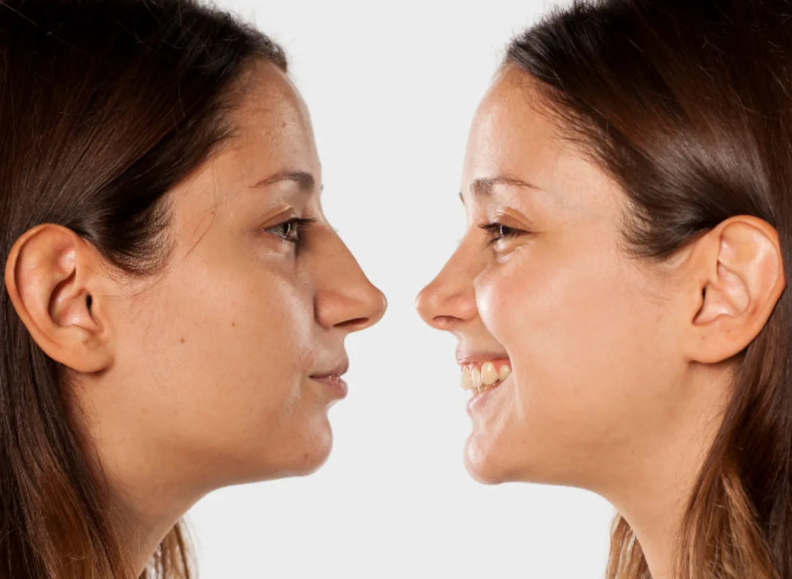 Rhinoplasty at Niraaya Hospital