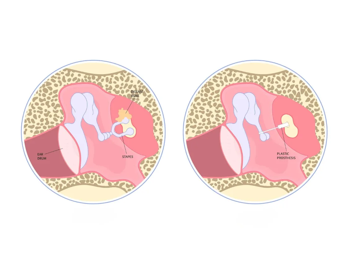 Stapedotomy hearing care at Niraaya Hospital