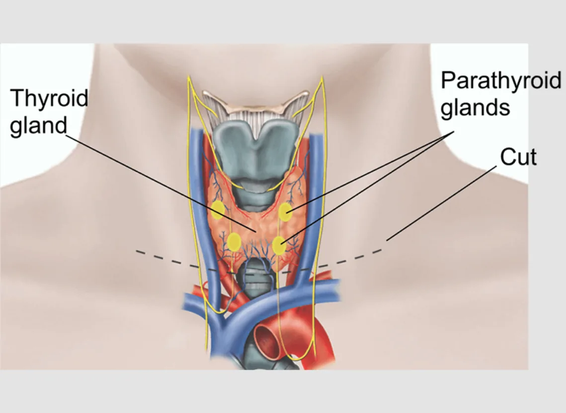 Thyroidectomy at Niraaya Hospital