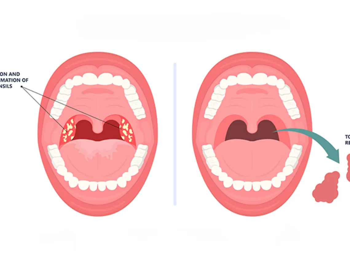 Tonsillectomy at Niraaya Hospital