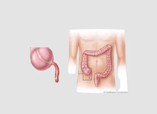 Appendectomy - Laparoscopic Appendix Removal consultation at Niraaya Hospital
