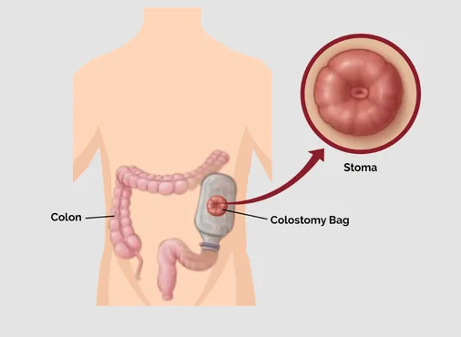 Colectomy - Laparoscopic Colon Cancer Surgery consultation at Niraaya Hospital