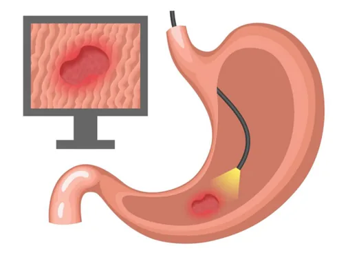 Endoscopy
