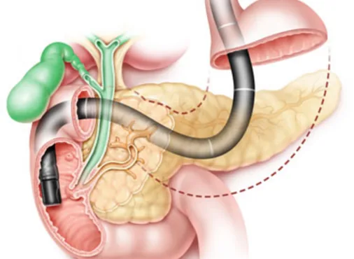 ERCP - Endoscopic Retrograde Cholangiopancreatography consultation at Niraaya Hospital