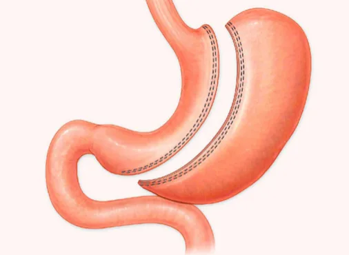 Gastrectomy - Surgical Treatment of Gastric Cancer consultation at Niraaya Hospital