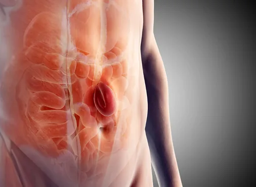 Hernia Surgery