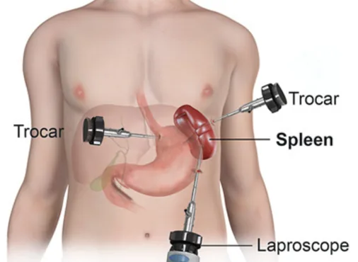 Splenectomy - Laparoscopic Spleen Removal consultation at Niraaya Hospital